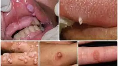 أعراض فيروس الورم الحليمي البشري HPV عند النساء والرجال