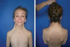 أعراض متلازمة تيرنر عند الفتيات