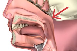 اعراض سرطان البلعوم الأنفي المبكرة