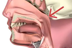 اعراض سرطان البلعوم الأنفي المبكرة