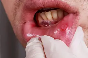 اعراض سرطان اللثة بالتفصيل