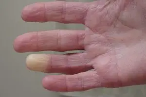 متلازمة رينود بالتفصيل