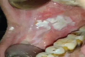 هل سرطان الفم مميت؟