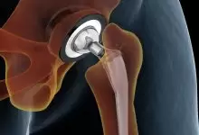 جراحة استبدال مفصل الركبة بالتفصيل