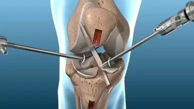 علاج تمزق اربطة الركبة بالجراحة