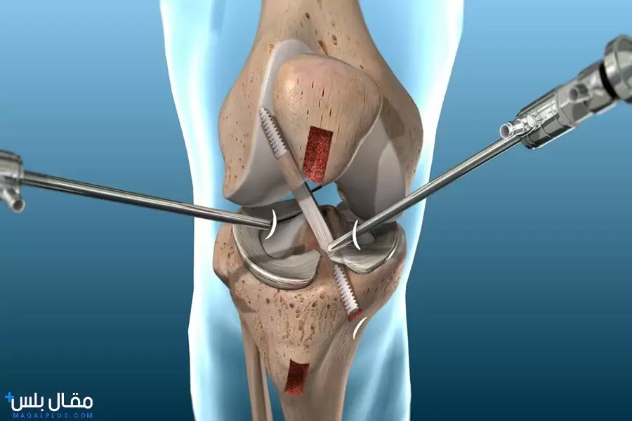 علاج تمزق اربطة الركبة بالجراحة