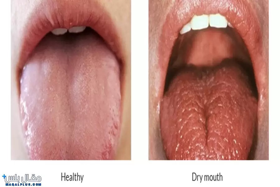 أسباب جفاف الفم