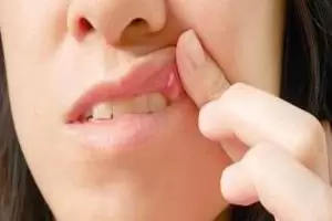 أسباب وأعراض تقرحات الفم