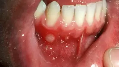 أسباب وعلاج قرحة الفم