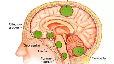 أنواع اورام المخ والأعصاب