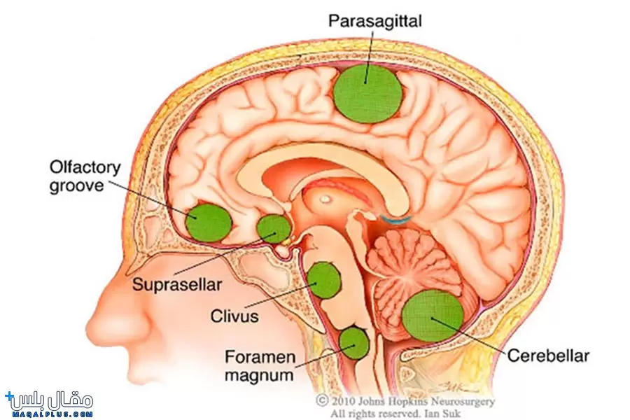أنواع اورام المخ والأعصاب