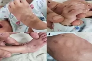 أعراض مرض فاربر عند الأطفال