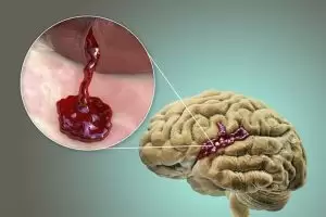 أضرار نزيف الدماغ