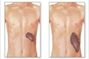 هل تضخم الطحال مرض خطير؟