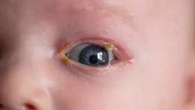 اسباب افرازات العين عند الرضع