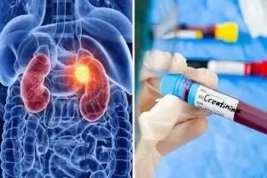 هل ارتفاع الكرياتينين في الدم يعني فشل كلوي؟