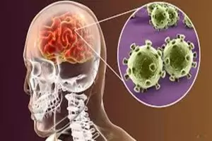 هل التهاب السحايا الفيروسي معدي؟