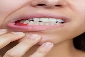 أعراض التهاب اللثة بالتفصيل