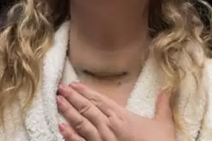 استئصال الغدة الدرقية والحمل